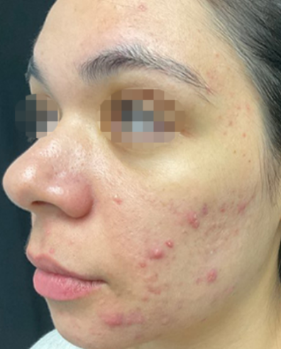 Close-up of a woman's face showing mild acne with red bumps and pimples on her cheek and jawline.