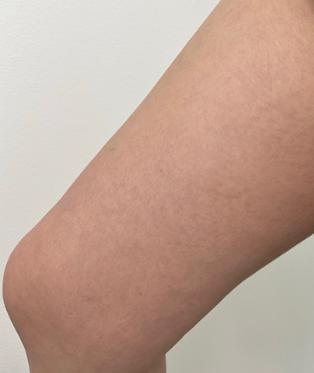 Close-up of a person's light-skinned arm showing mild skin dryness and slight redness.
