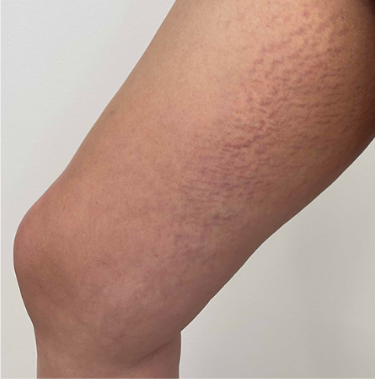Close-up of a person's arm showing signs of stretch marks.
