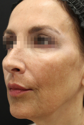 Close-up of a woman's face with visible skin imperfections and uneven texture, with her eyes pixelated.