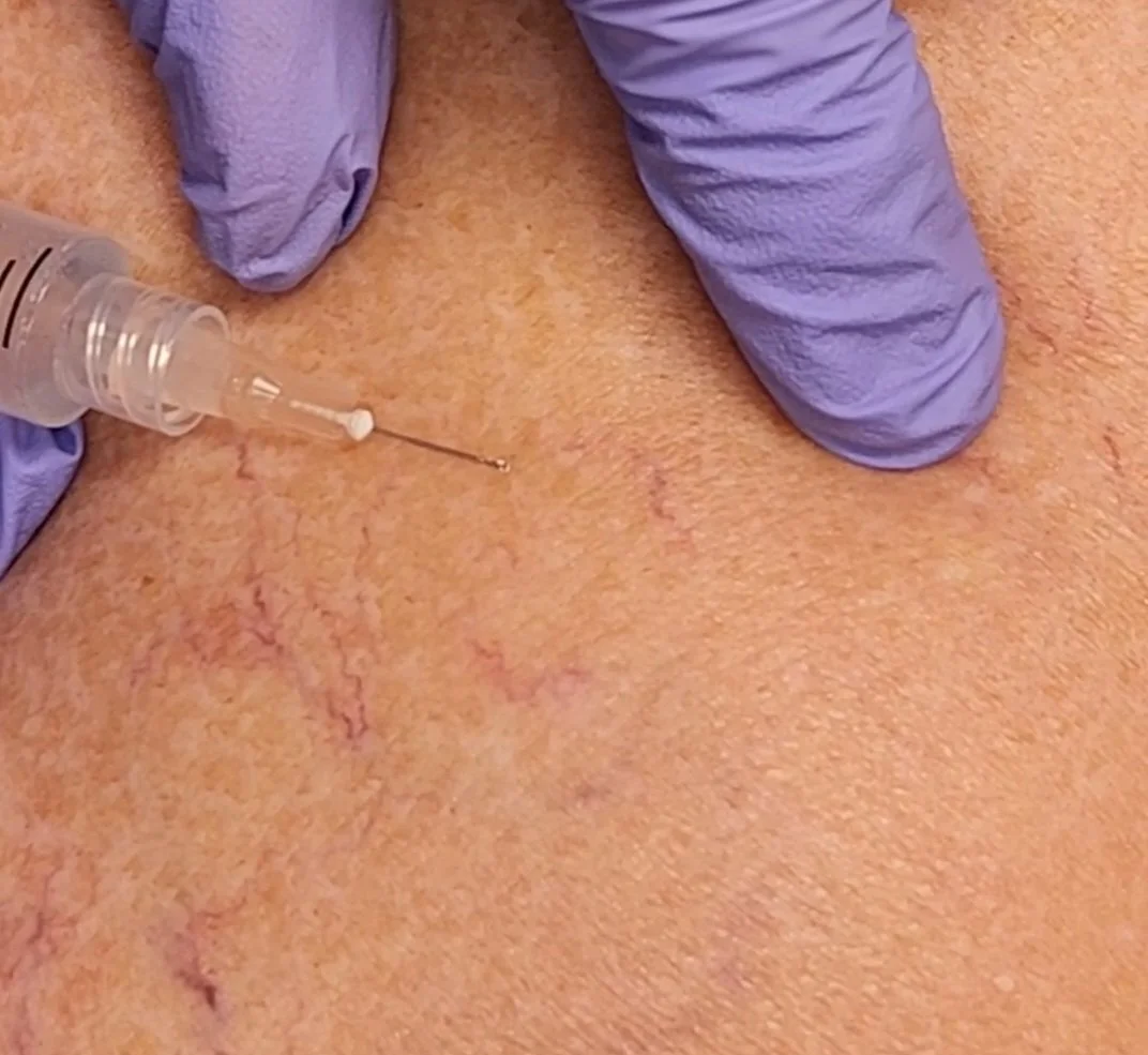 A medical procedure involving a syringe injecting a substance into the skin with visible veins and skin texture.