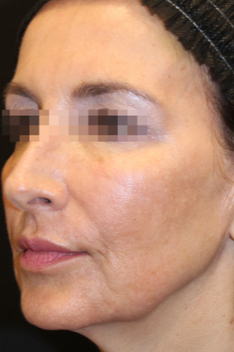 Close-up of a woman's face with a focus on her cheek and eye area, wearing a black headband. The eyes are pixelated to protect identity.