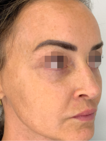 Close-up of a woman's face showing skin with acne scars and pigmentation, focusing on the right side of her face.