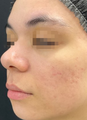 Close-up of a woman's face showing skin with acne scars and redness.