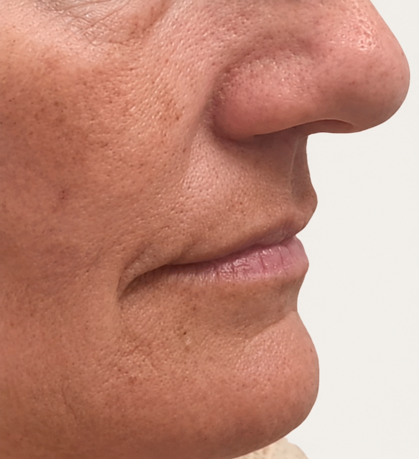 Close-up profile of a person's nose, lips, and chin, showing detailed skin texture.