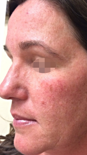 Close-up of a woman's face showing red, irritated skin and acne scars on her cheek and forehead.