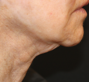 Close-up of a person's lower face and neck showing signs of aging