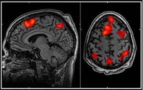 fmri scan that shows brain lighting up during memory tasks