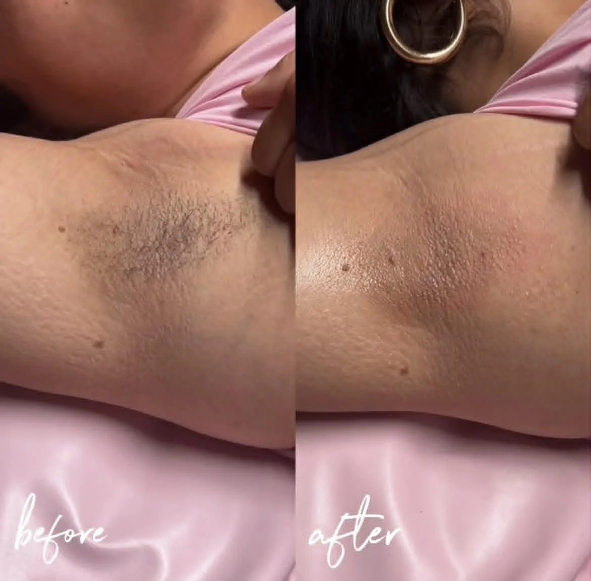 Comparison of armpit hair removal, showing a before and after of a woman's armpit with hair on the left and smooth skin on the right, with the words 'before' and 'after' at the bottom.