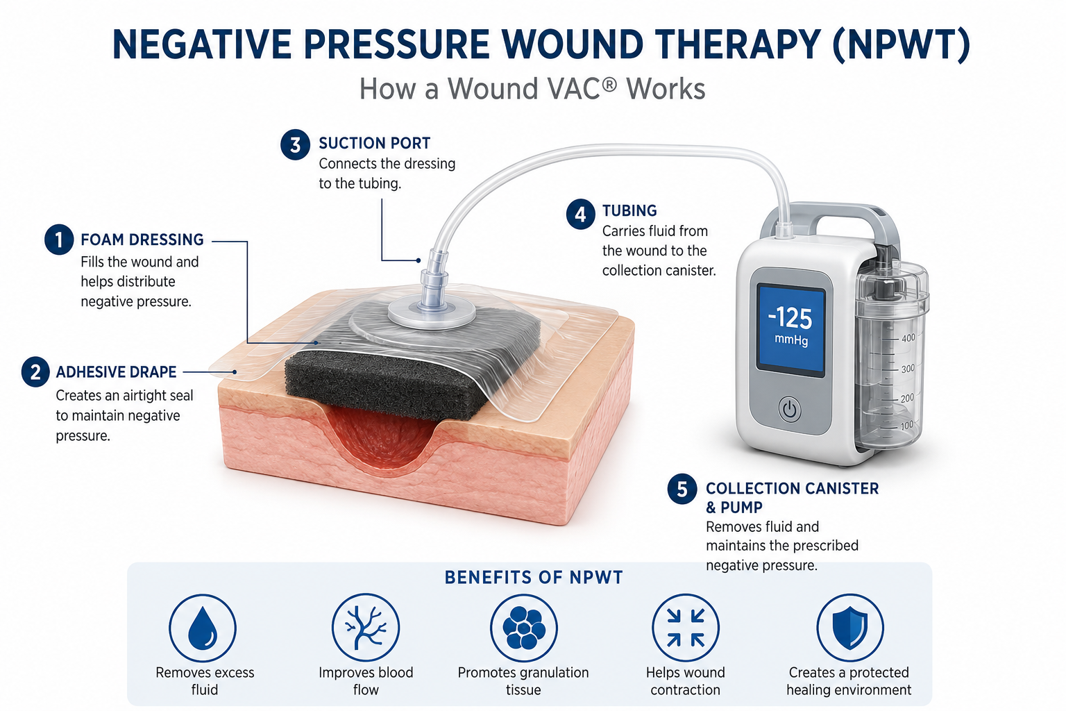 The Complete Beginner's Guide to Negative Pressure Wound Therapy (NPWT)