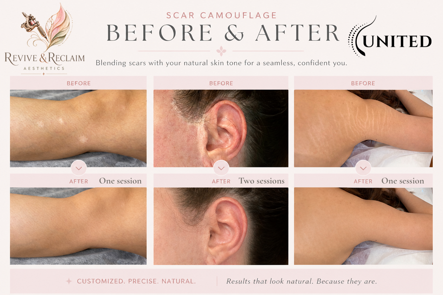 Comparison of scar camouflage treatments showing 'before' and 'after' images for three different scars on different body parts. The treatments result in less visible scars after one or two sessions.