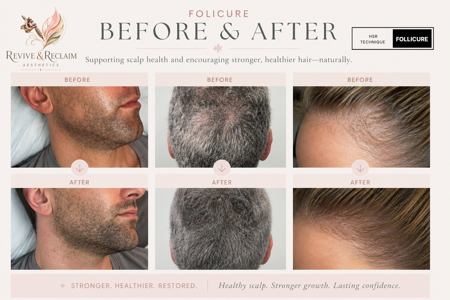 Comparison of before and after hair restoration treatments on three individuals, showing improved scalp health and thicker hair in the after images.