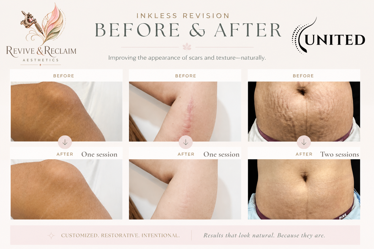Comparison of skin before and after inkless scar revision treatment from Revive & Reclaim Aesthetics, showing skin improvement across three body areas with 'Before' and 'After' photos and session details.