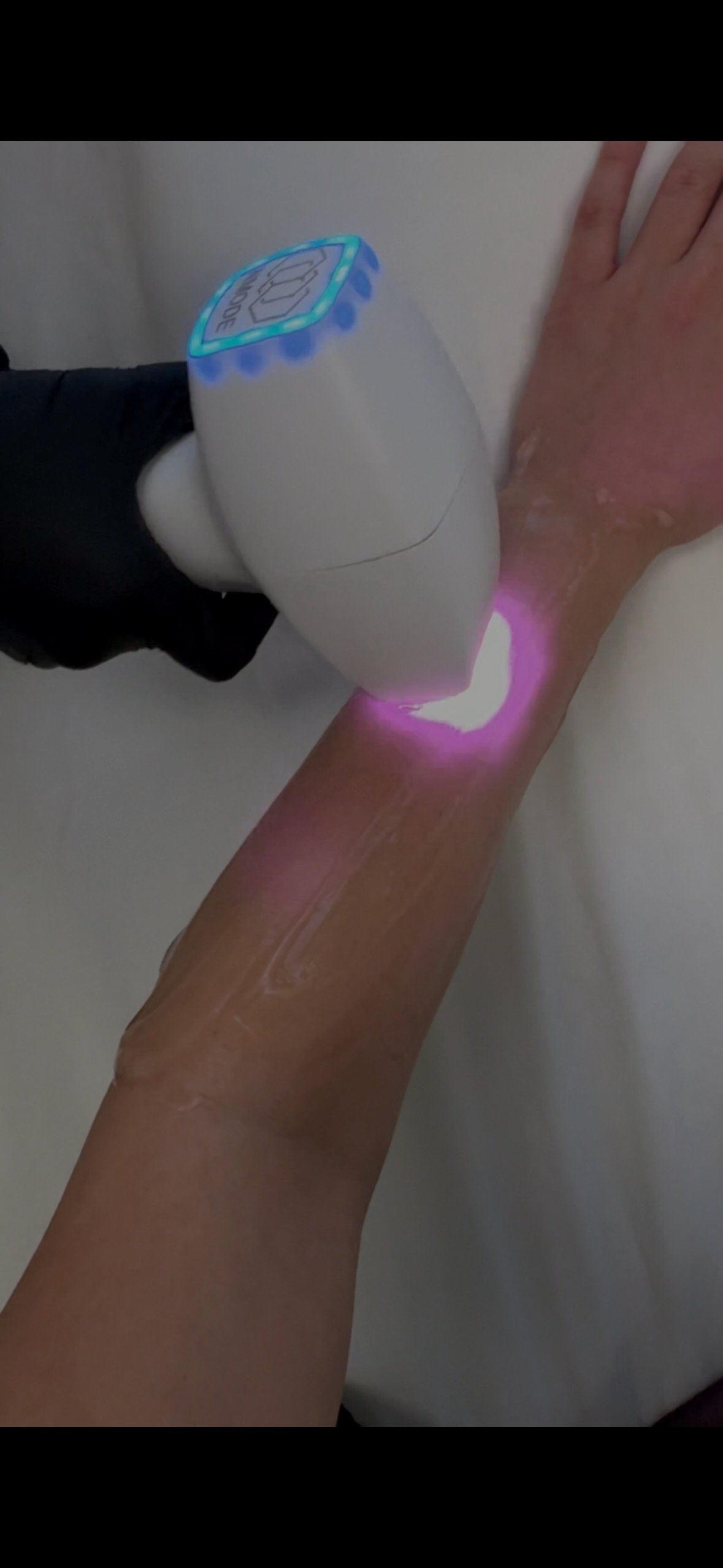 Laser Hair Removal