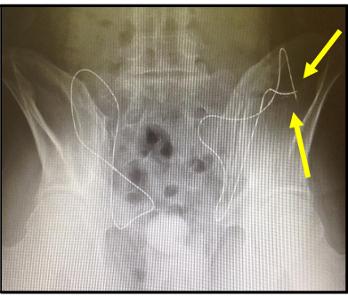 Nitinol Framed Hernia Repair Device