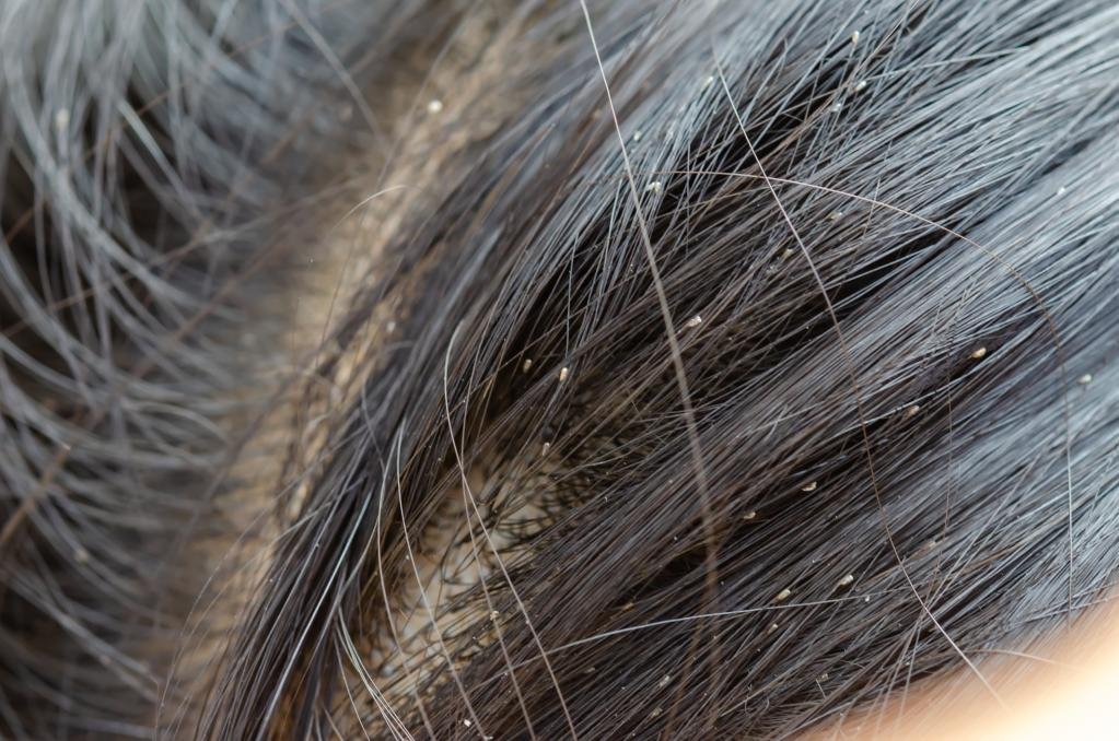 get rid of lice in 1 day