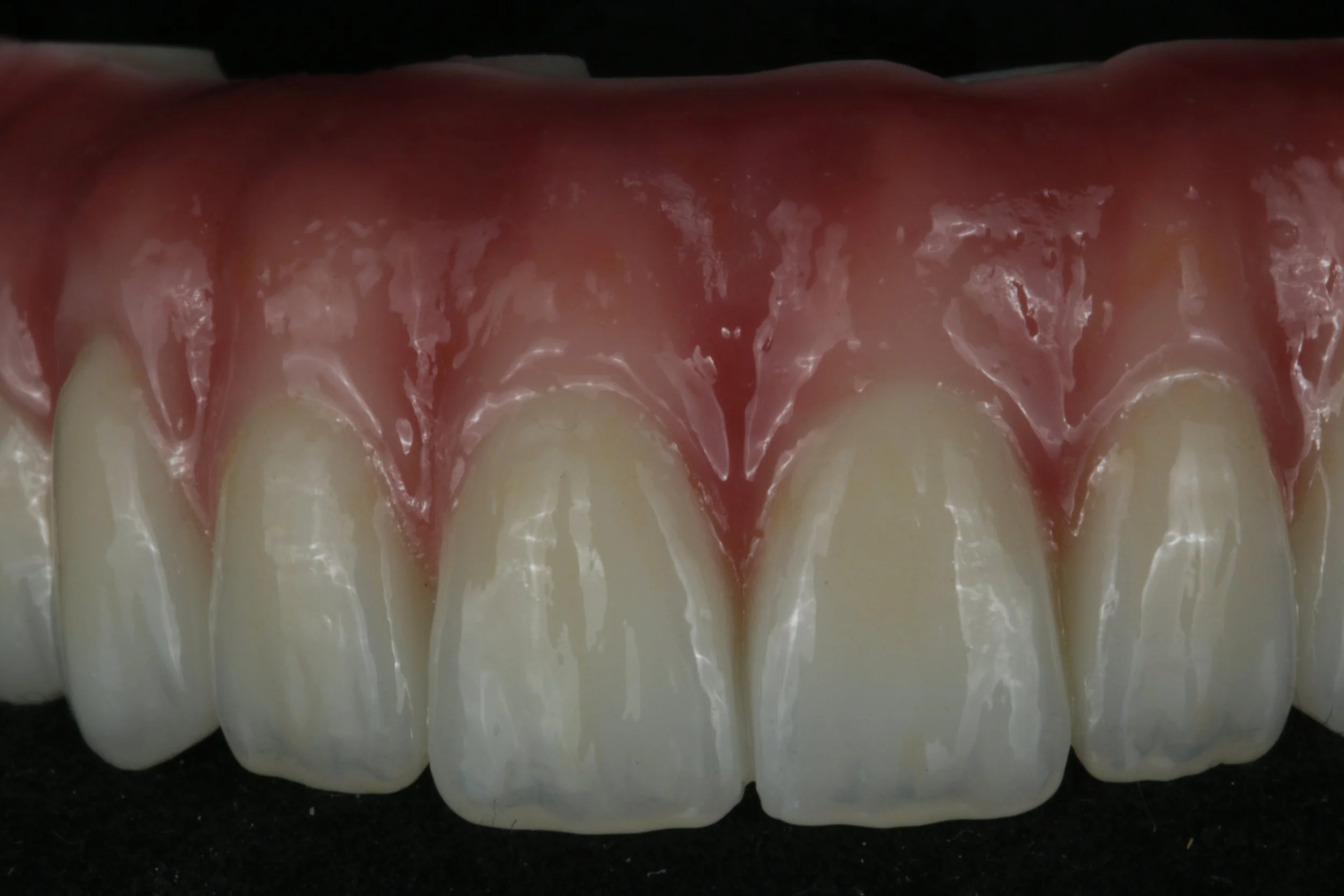 Monolithic Zirconia Hybrid Restorations at WSDL