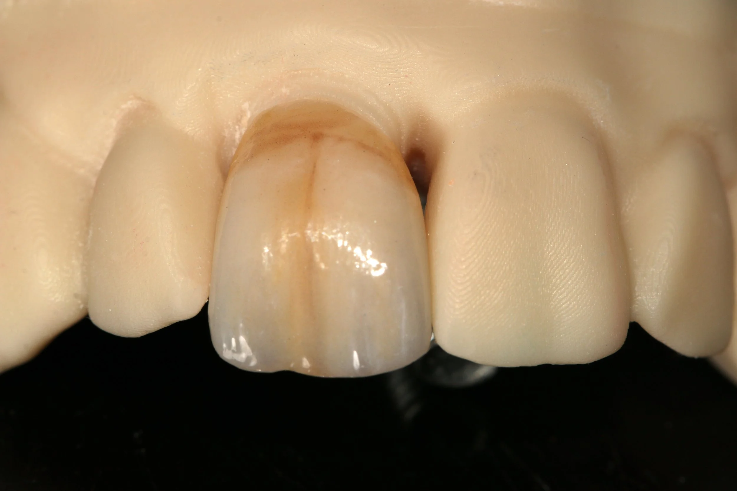 Close-up of four human teeth with some brown staining near the gum line, set against a black background.