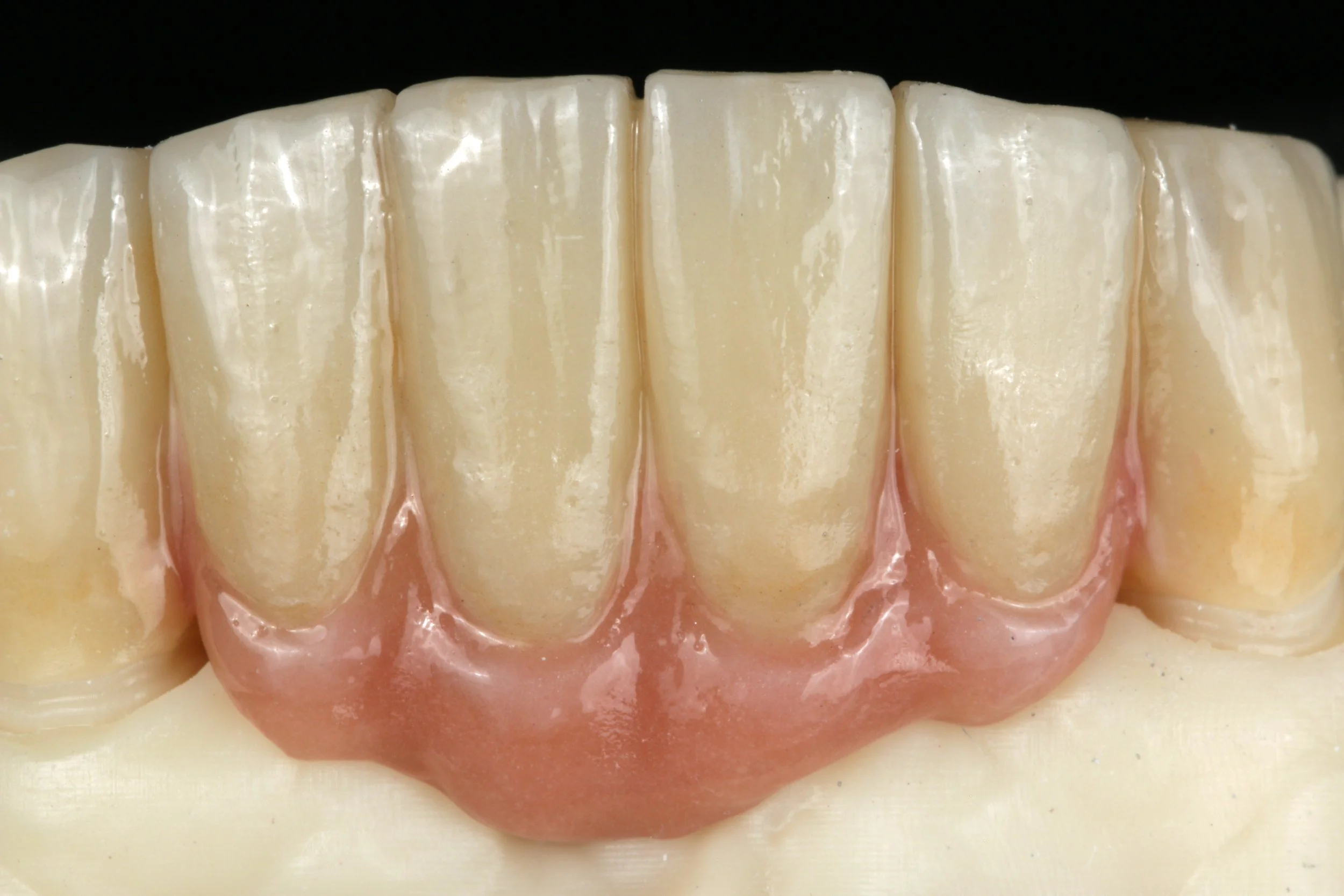 Close-up of a dental model showing a set of front teeth with gums.