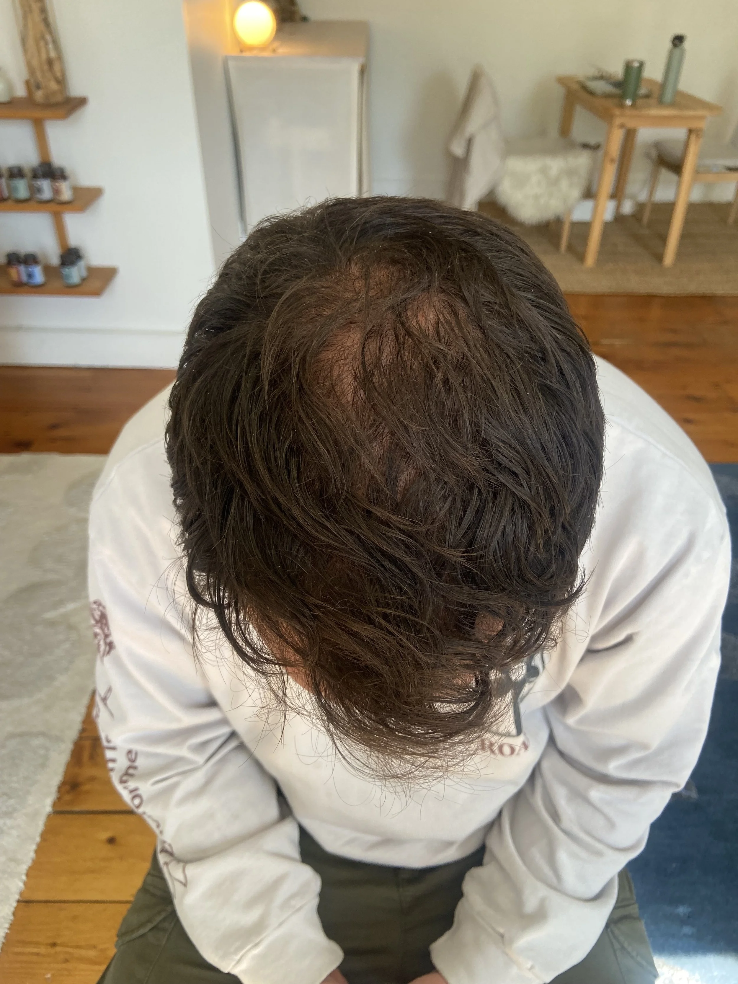 Micro Hair after 2 sessions.jpeg