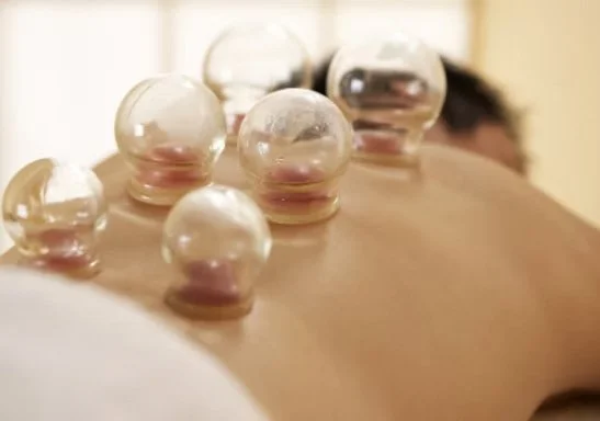 Close-up of multiple glass cupping therapy cups on a person's back, with a blurred background of a person.