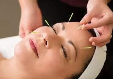 Person receiving acupuncture treatment on face with multiple thin needles inserted