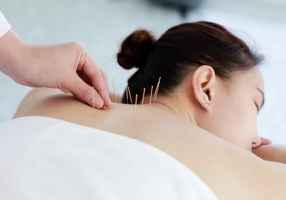 A woman receiving acupuncture treatment on her back with multiple acupuncture needles inserted.