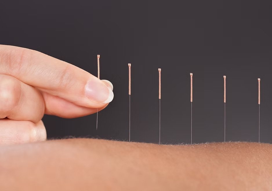 A hand with a needle inserted into skin, with several other needles in a row behind it, indicating acupuncture treatment.