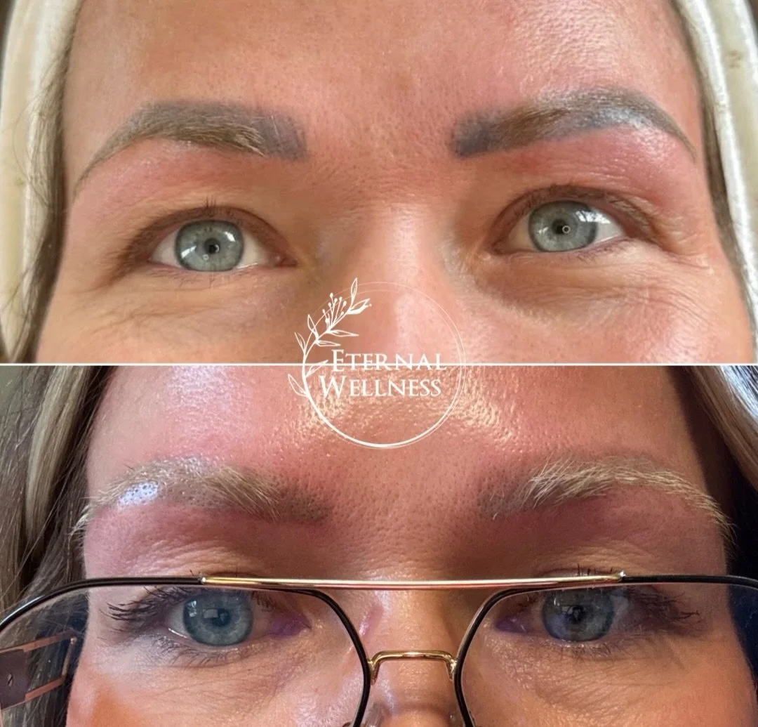 ✨ BROW TRANSFORMATION ✨

Top: Before brow tattoo removal
Bottom: Immediately after the 3rd treatment with our TORO&trade; system 👏🏽 🔥 

At Eternal Wellness, we&rsquo;re proud to be the ONLY spa in Northern Michigan offering tattoo removal with the