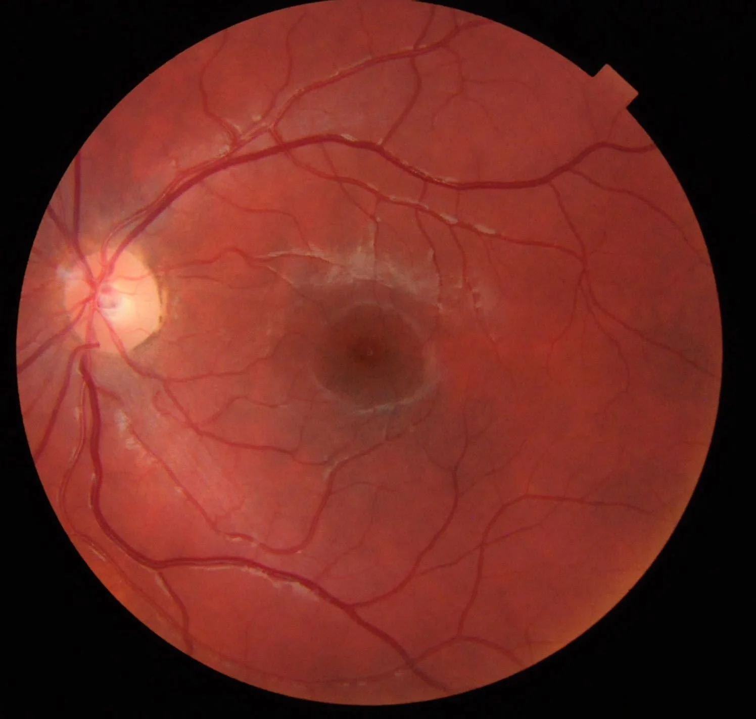 Retinal photograph of an eye showing blood vessels, optic disc, and macula with a dark center.