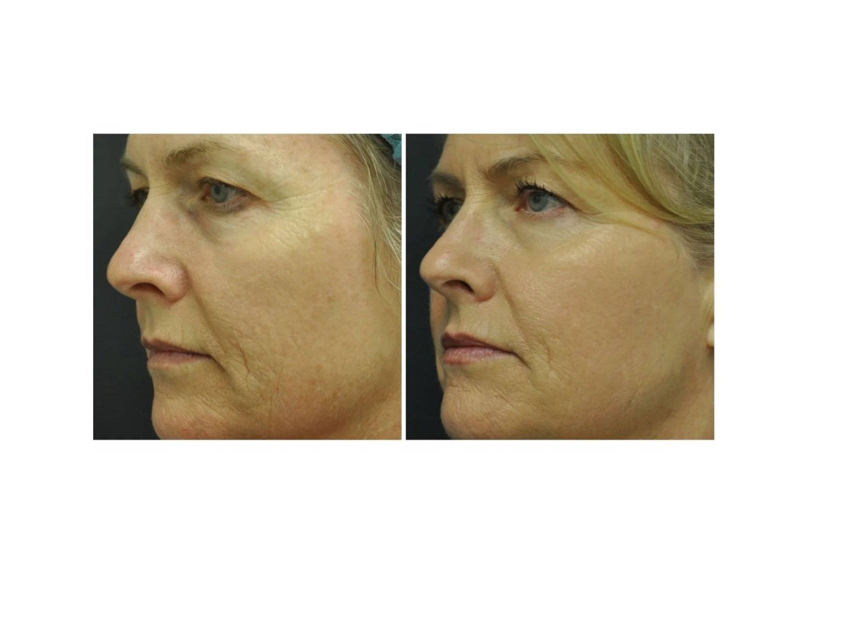 San Diego Laser Resurfacing 