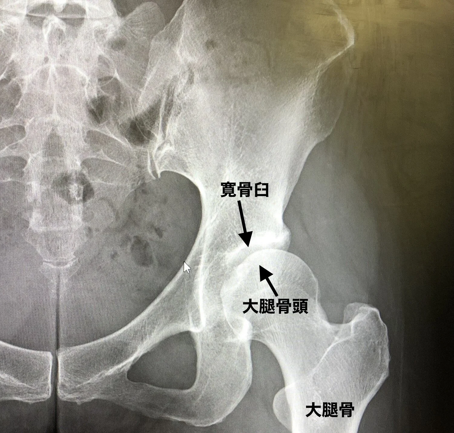 寛骨臼形成不全からの関節唇損傷、そしてリハビリ始めました