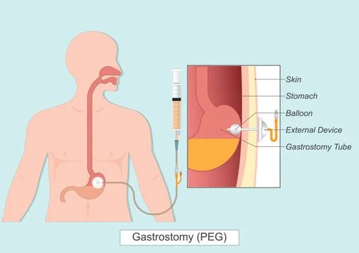 Diagram of a gastrostomy (PEG) tube inserted into a person's stomach showing skin, stomach, balloon, external device, and gastrostomy tube, with a close-up of the tube insertion site.
