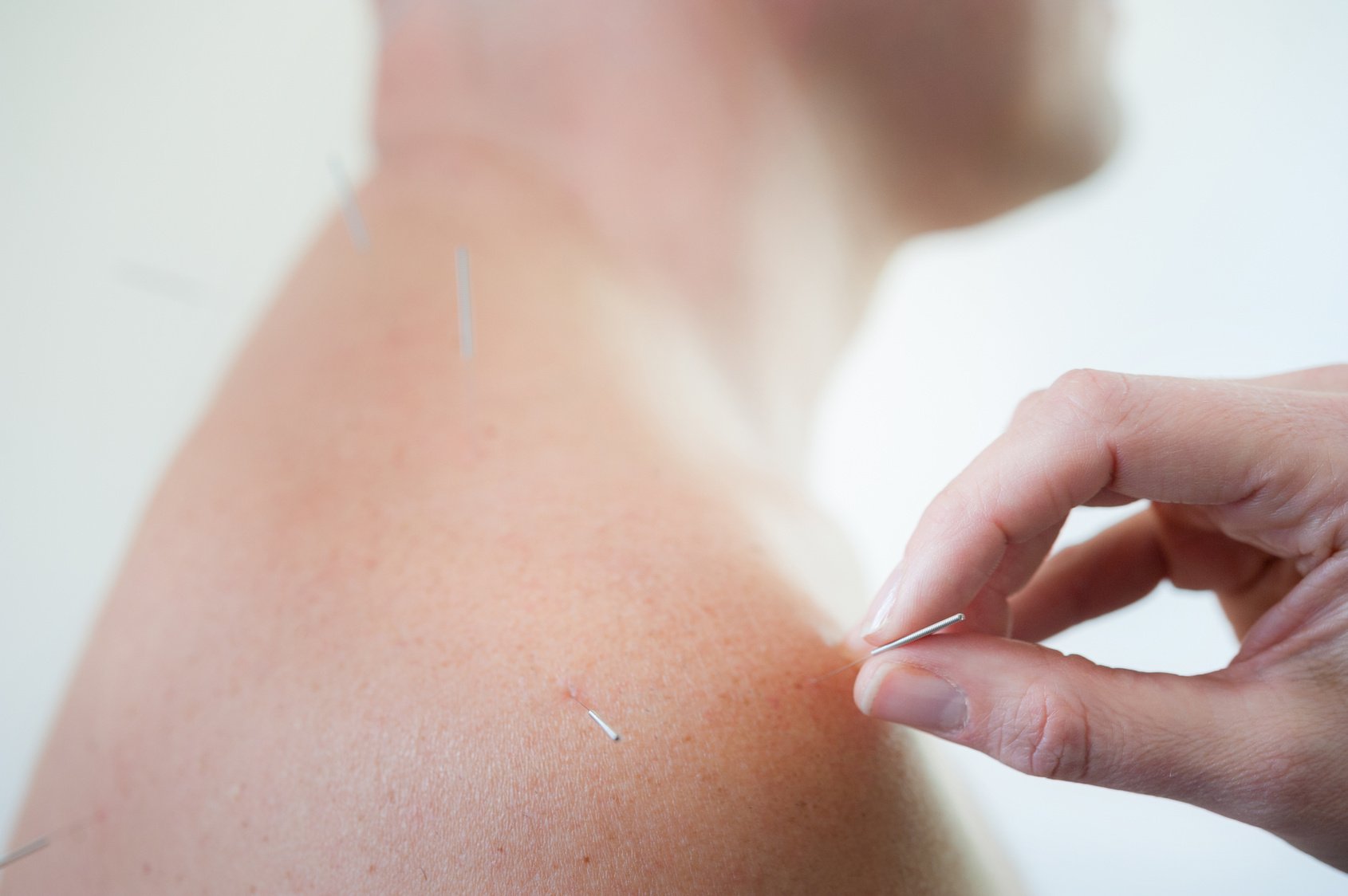 Close-up of a person receiving acupuncture treatment on their shoulder with thin needles being inserted by a practitioner's hand.