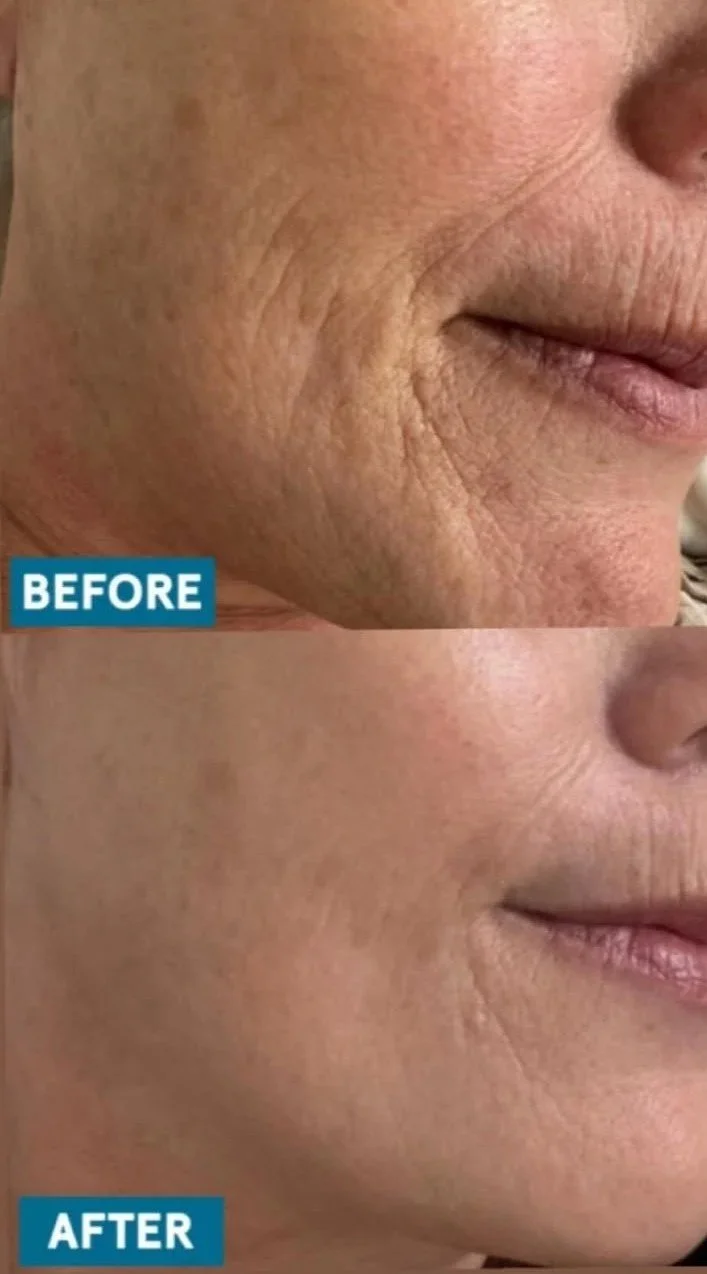 Close-up of a person's cheek and mouth showing before and after skin improvement; the 'before' side has visible wrinkles and rough texture, while the 'after' side has smoother skin.