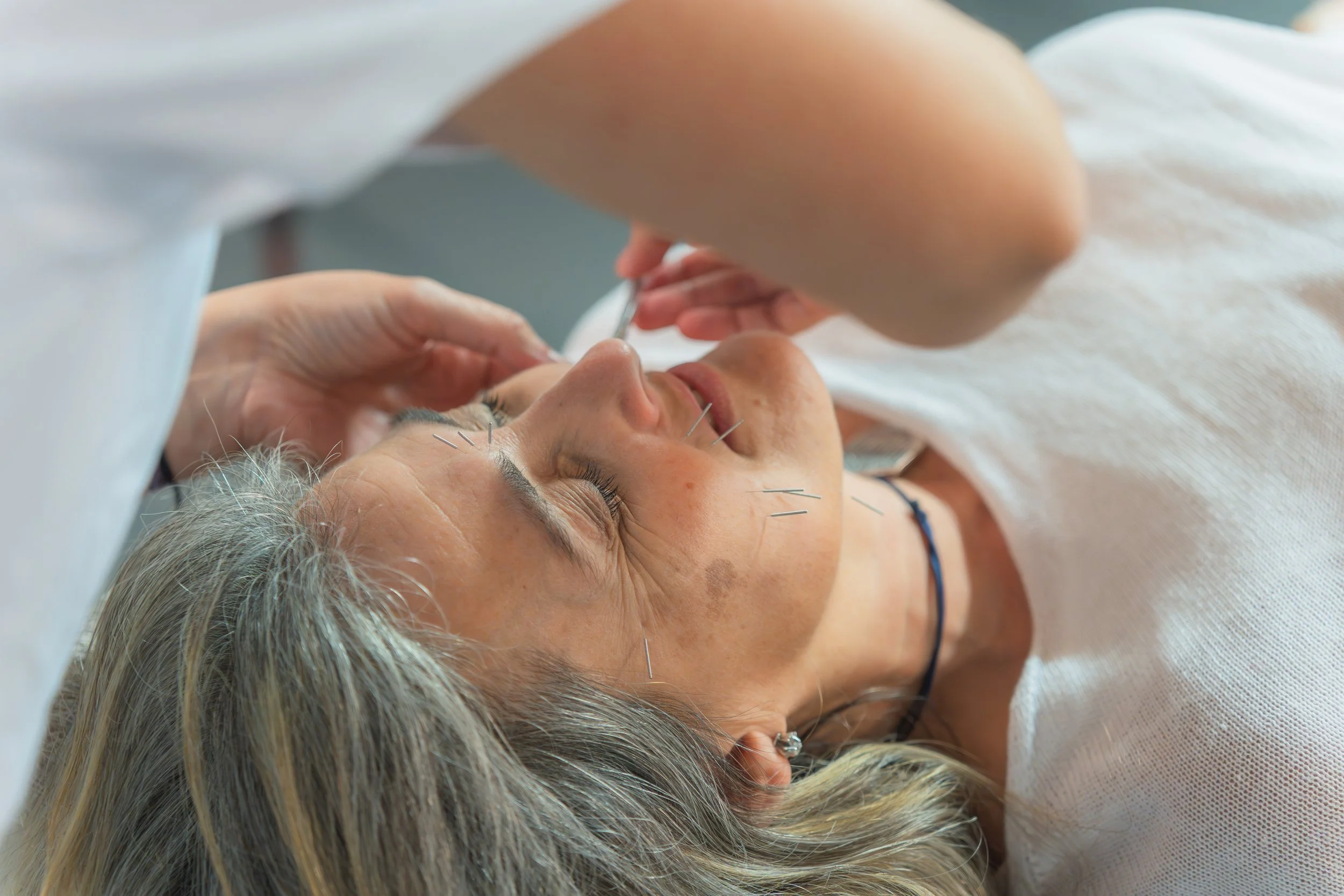 An elderly woman with short gray hair receiving acupuncture treatment with thin needles inserted into her forehead, lying on a treatment table.