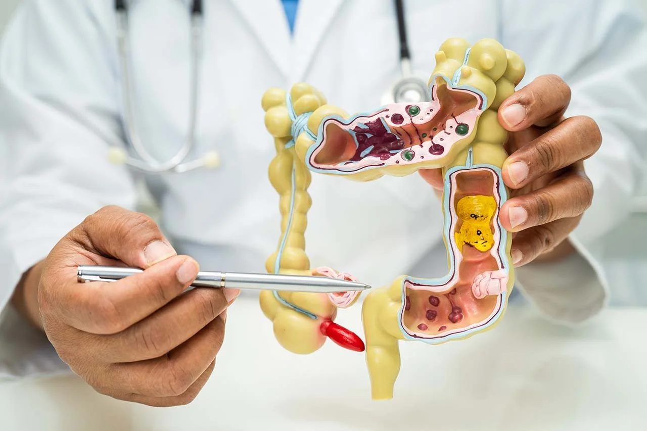 Doctor holding a model of the human large intestine with sections showing internal details such as bacteria, polyps, and fecal matter.