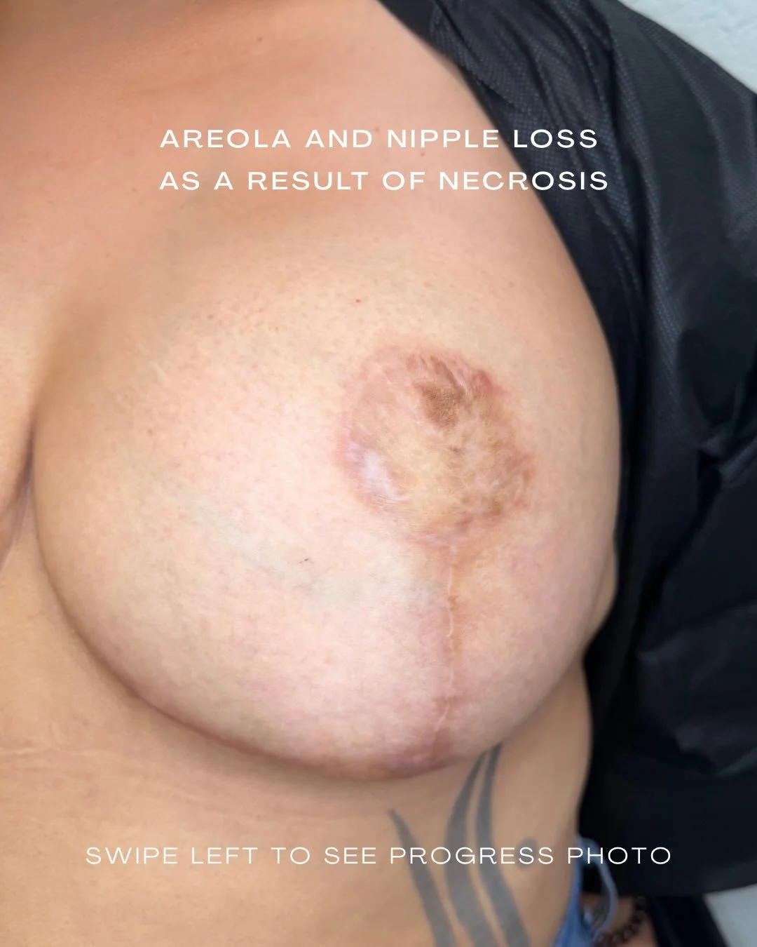 So this is something I don&rsquo;t think gets talked about enough, and with my client&rsquo;s permission I&rsquo;m sharing this to bring some awareness.⁣
⁣
What you&rsquo;re seeing in this photo is the result of necrosis. My client had a breast reduc