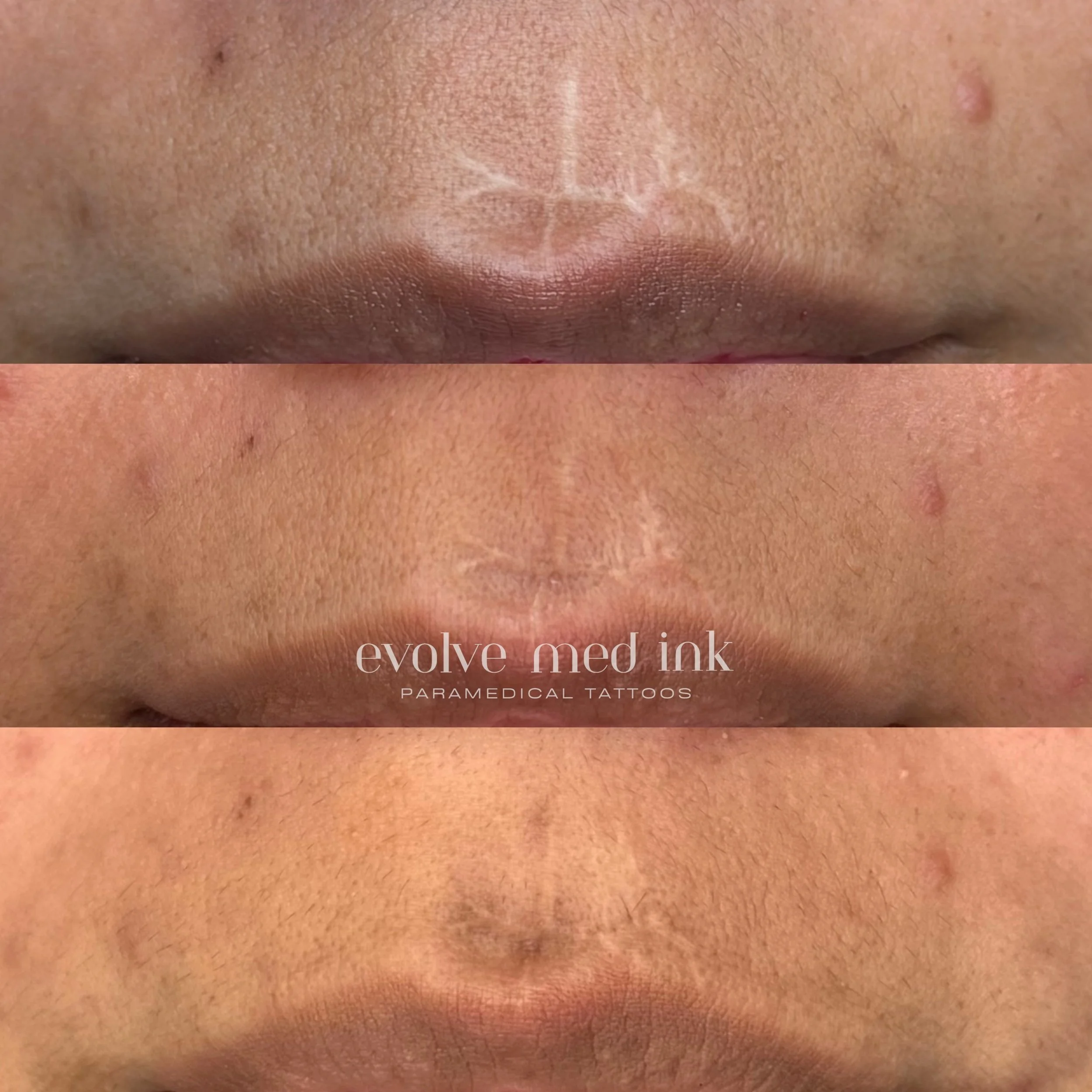 Before &rarr; 1 session &rarr; 2 sessions. 🤍⁣
⁣
This is what the process looks like &mdash; and this is why we don&rsquo;t rush it.⁣
⁣
Could a third session refine a few small spots? Maybe. But when my client feels confident, my work is done. That&r