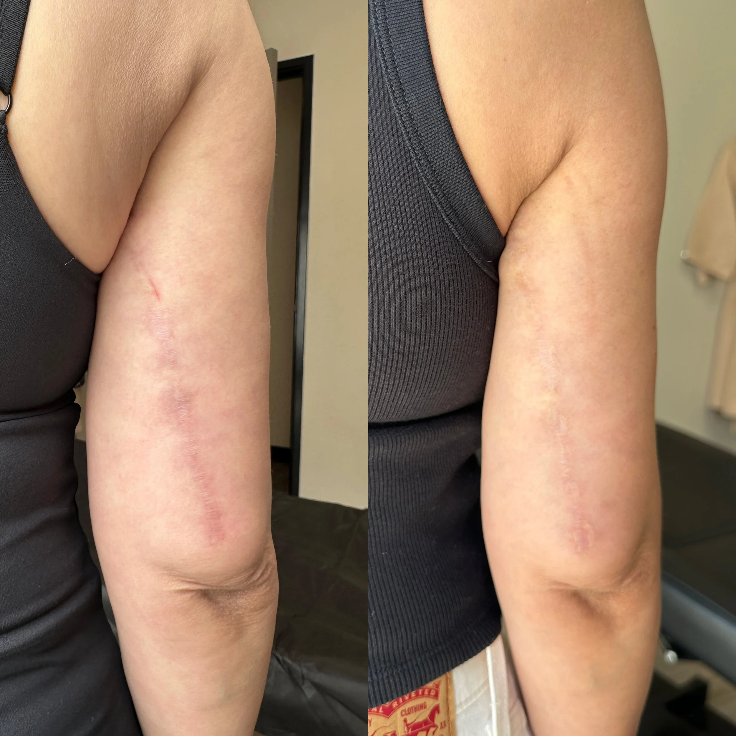 Scar Camouflage vs. Laser: What Actually Works for Discoloration