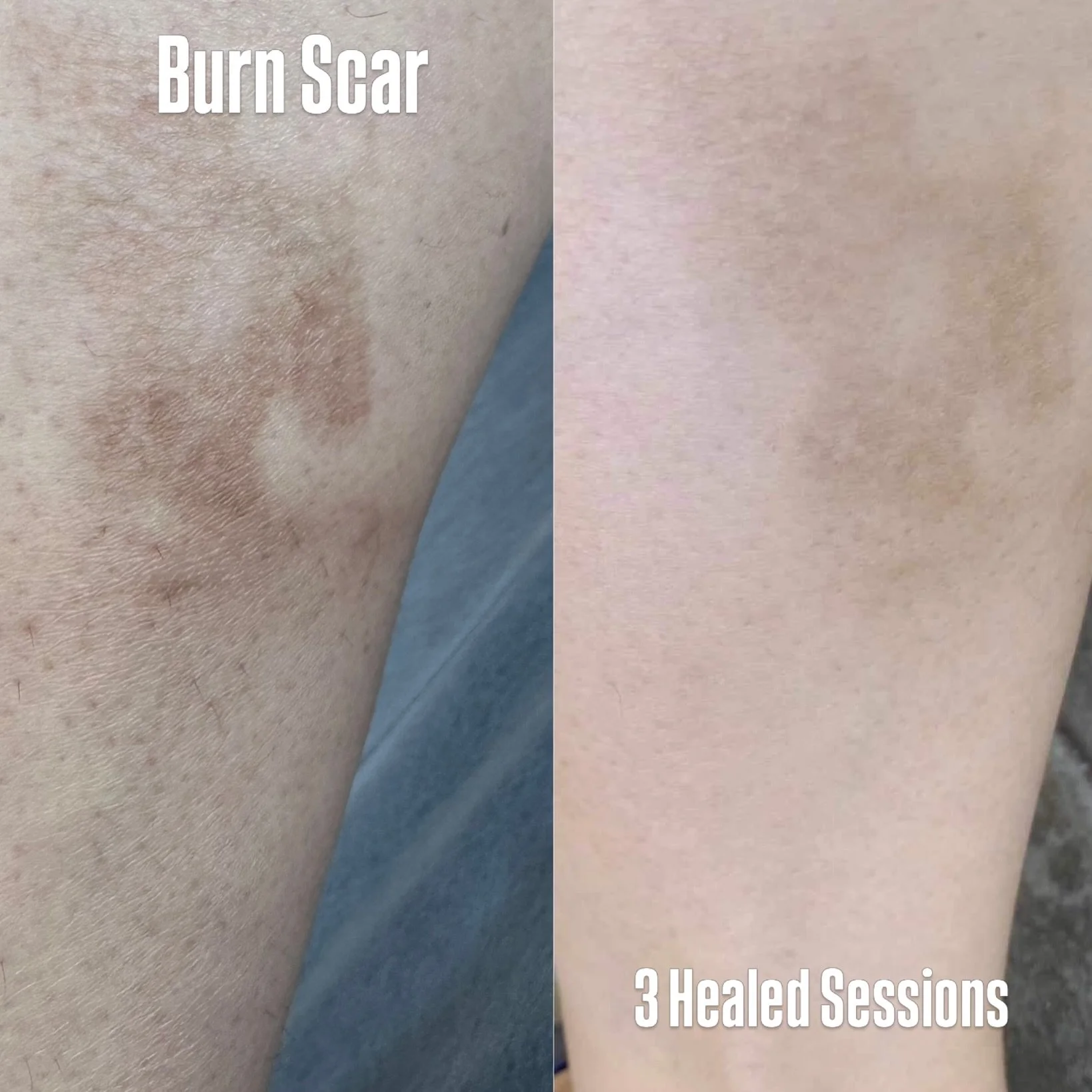 ⁣
⁣
Burn scars can heal thicker than other types of scar tissue, which means the skin itself behaves differently under the needle. That was the case for this client&rsquo;s lower calf. Thicker tissue takes more time and care to saturate properly, and