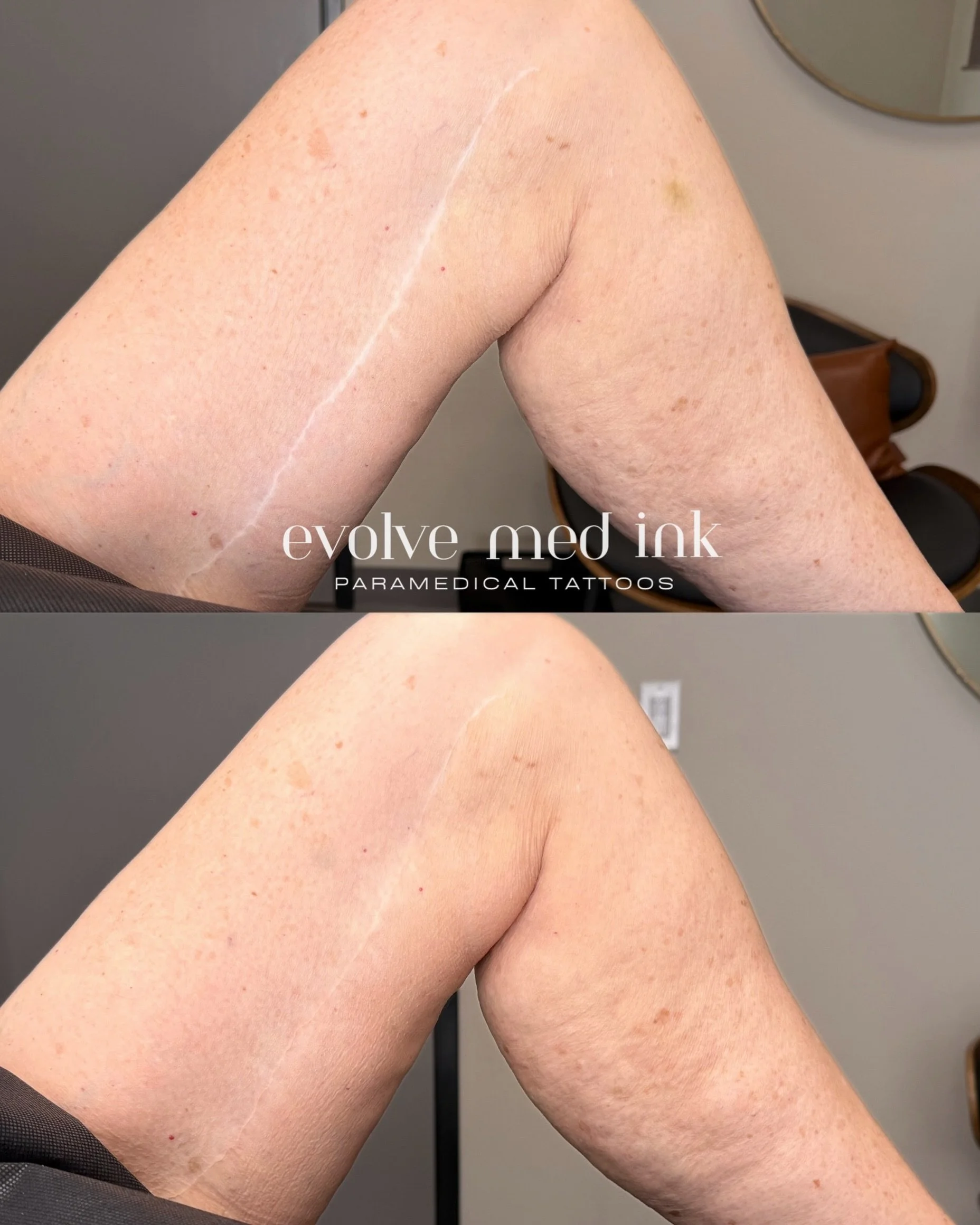Would you have guessed this is just ONE session in? 👀⁣
⁣
This client had a thigh lift after major weight loss, and this scar has been there for years since her body contouring surgery. One session of scar camouflage, and you can already see the colo