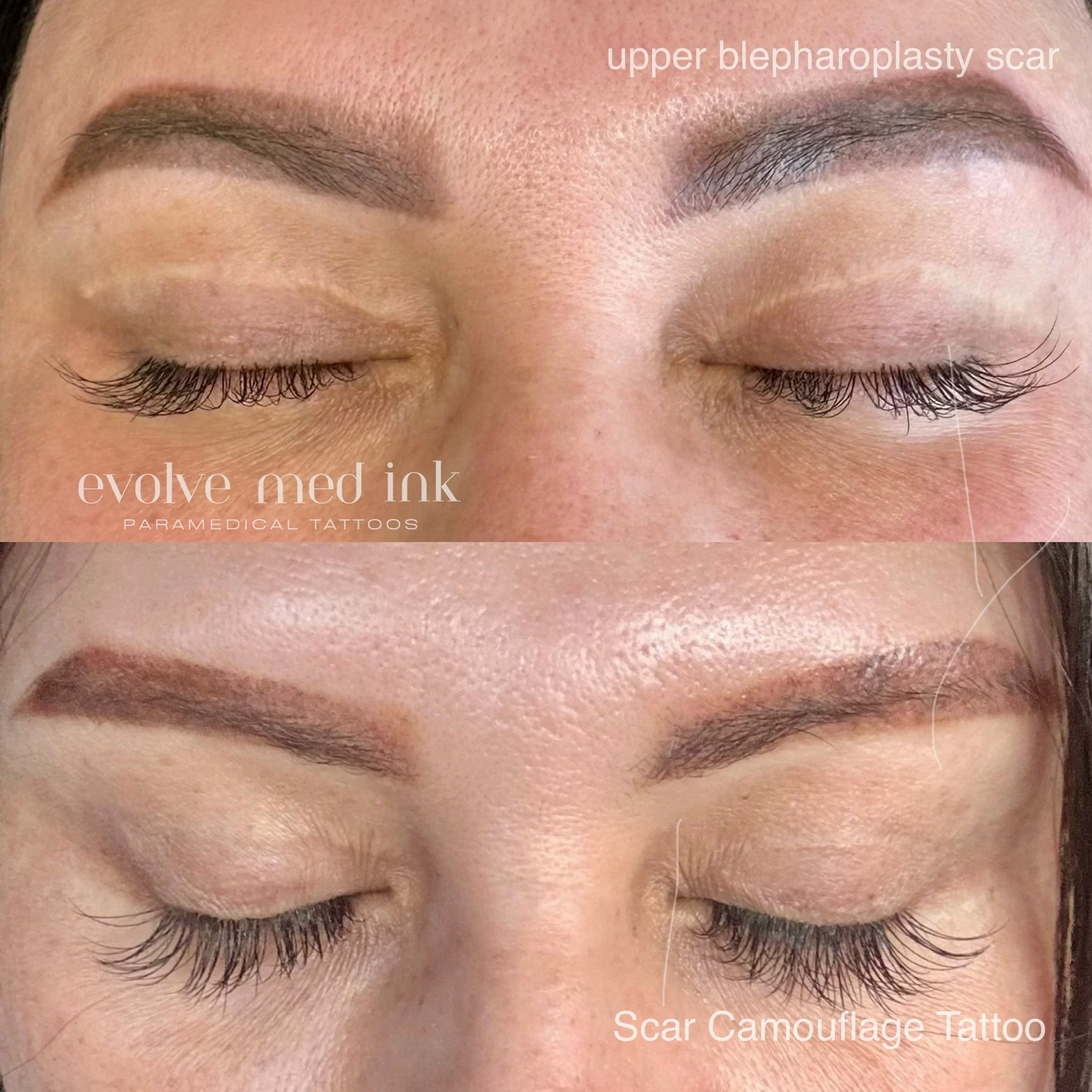 Scar camouflage on an upper blepharoplasty scar. 🤍⁣
⁣
An upper blepharoplasty is eyelid surgery that removes excess skin and fat from the upper eyelid, often done to correct drooping eyelids or for cosmetic reasons. It can leave a fine scar along th