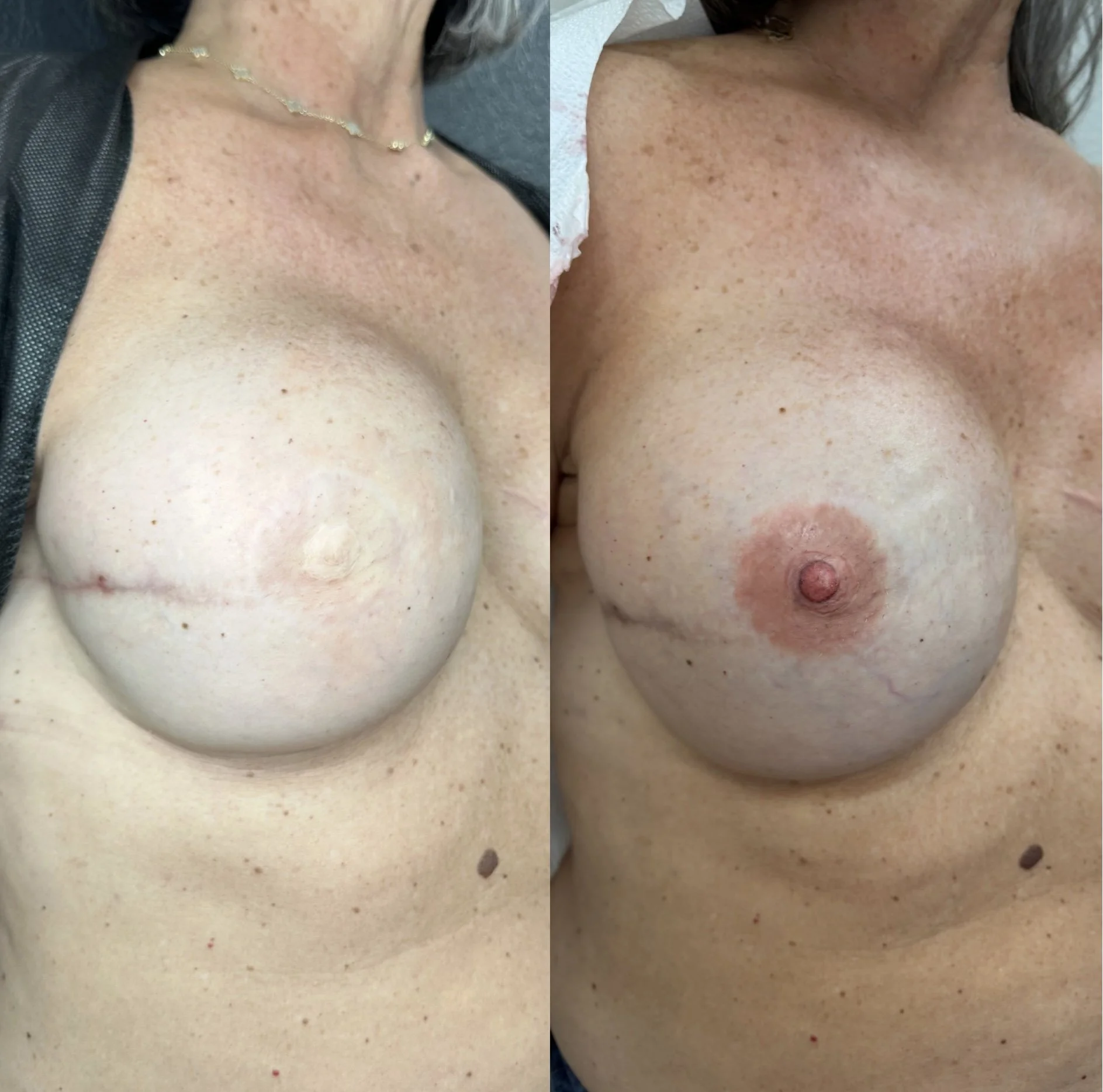 3D areola and nipple tattoo after breast reconstruction and mastectomy by Evolve Med Ink