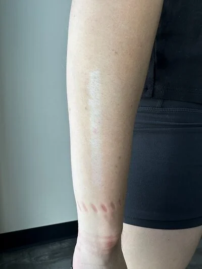 laser scar before.jpg