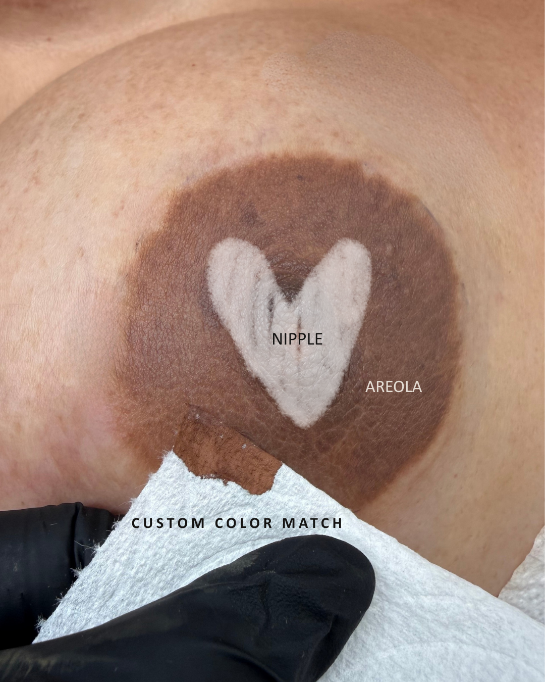 Scar camouflage tattoo before and after by Evolve Med Ink