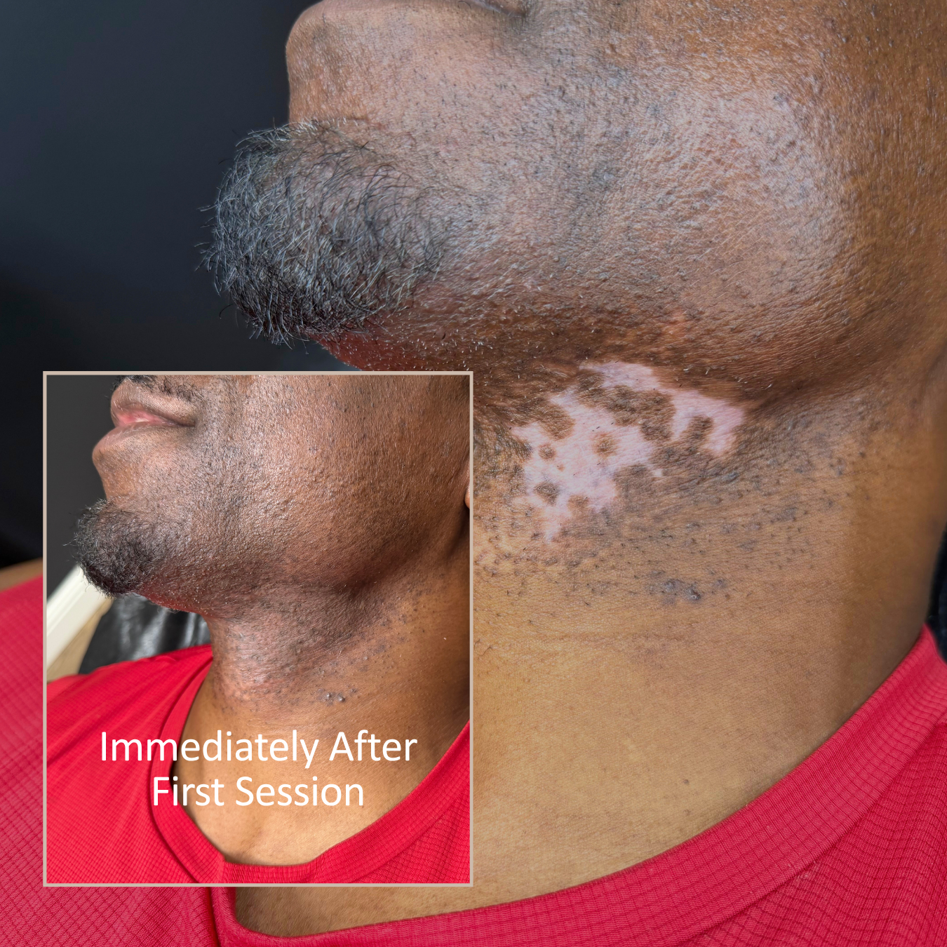 Vitiligo.png