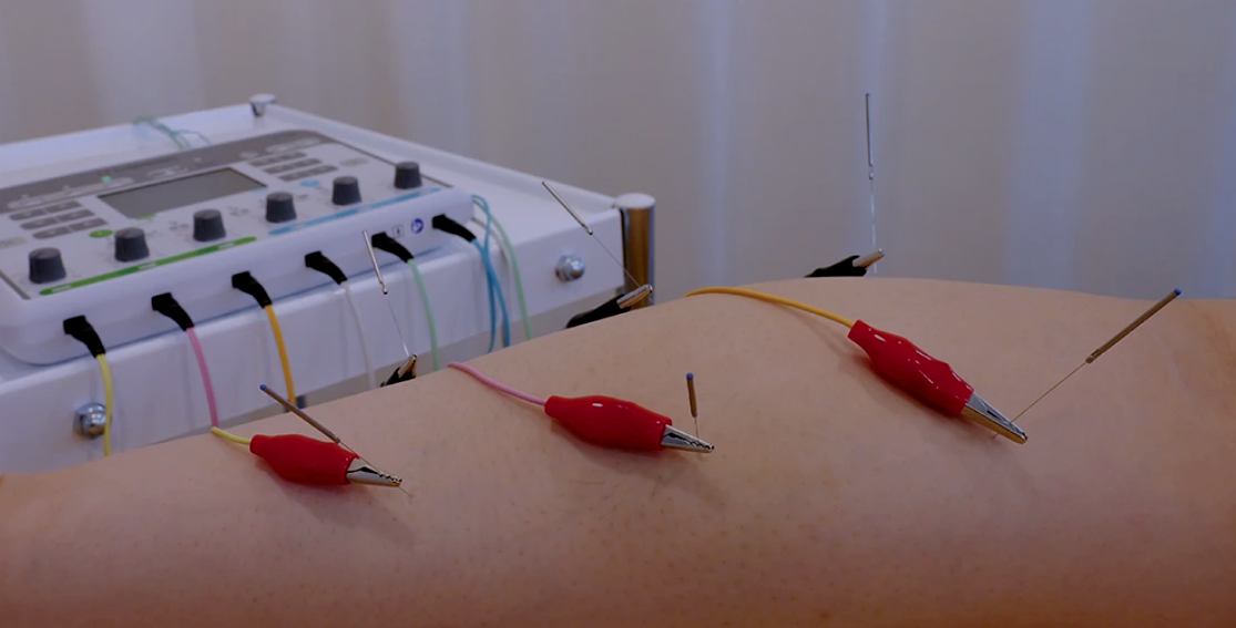 POWER ACUPUNCTURE in Rockville, MD provides electro-acupuncture stimulation therapy for pain relief, muscle recovery, nerve support, and holistic wellness.