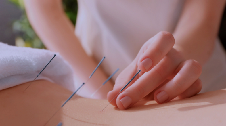 Traditional Acupuncture