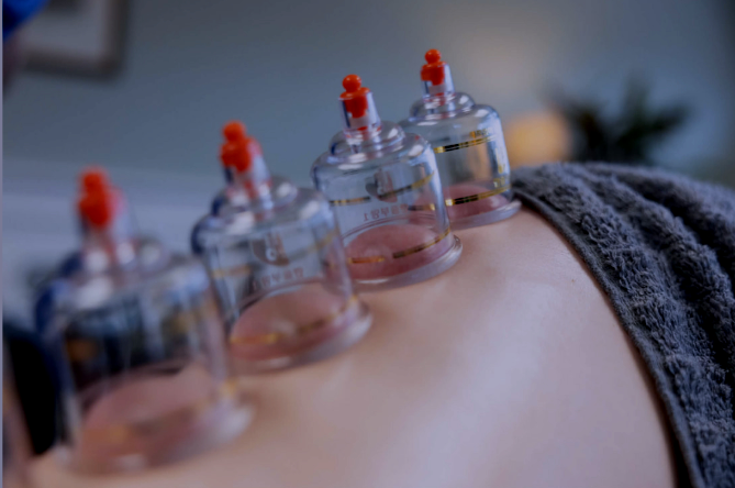 Cupping Therapy